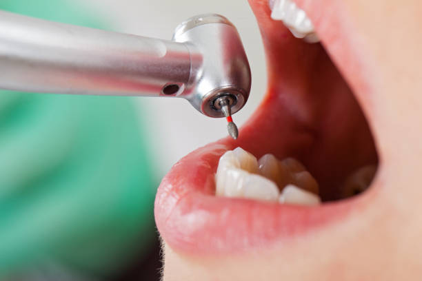 Best Same-Day Emergency Dentist in Desnso, CA